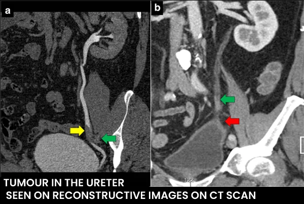 URETRIC TUMOR