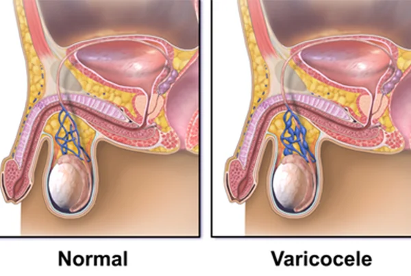 VARICOCELE